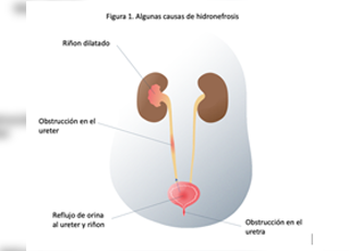 HIDRONEFROSIS PRENATAL